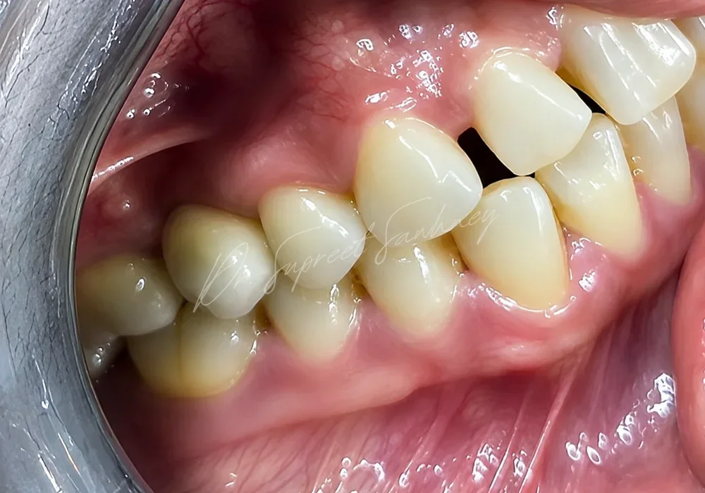 Second lateral intraoral photograph of the posterior maxillary implant restoration